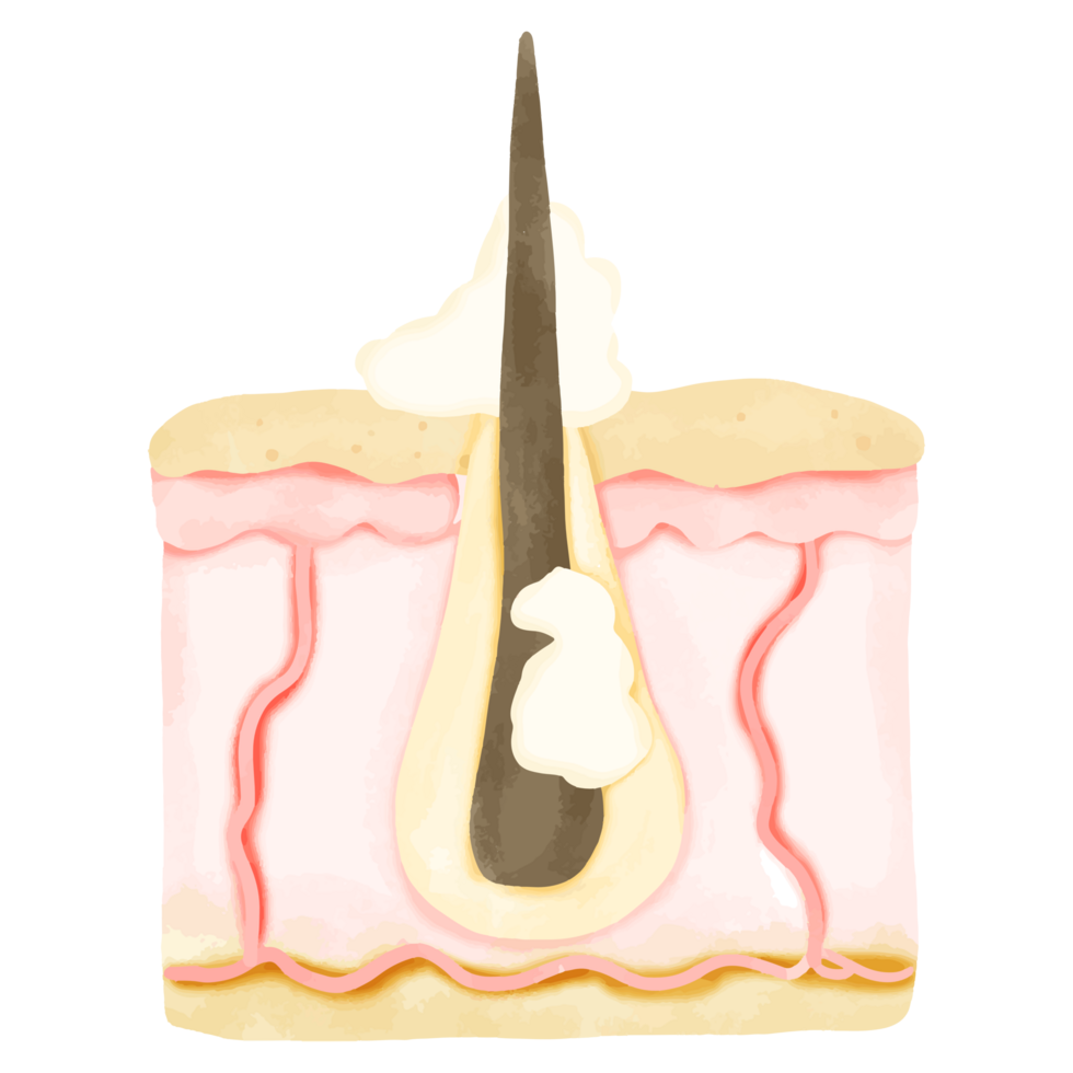 Watercolor Illustration of Hair Follicle with Sebum Overproduction png