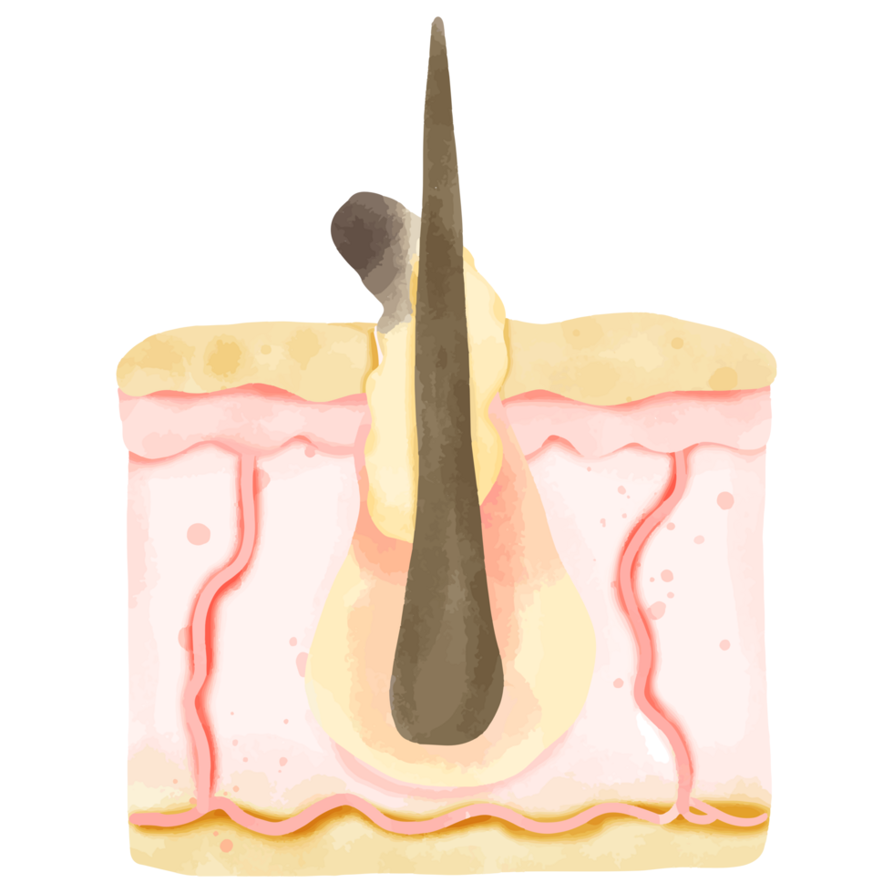 Watercolor Illustration of Hair Follicle with Sebum Buildup and Acne png
