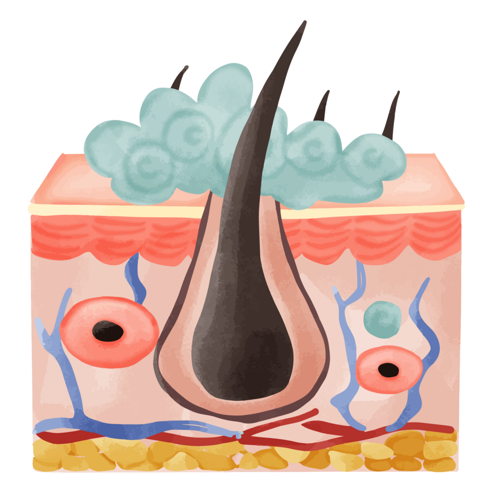 Watercolor Illustration of a Hair Follicle with Sebaceous Hyperplasia png