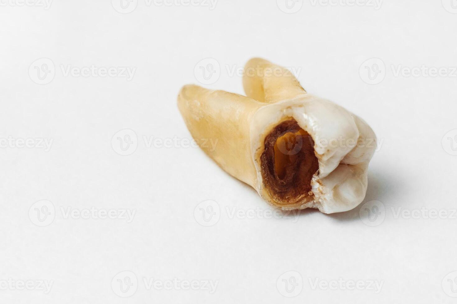 One tooth pulled out with big hole caused by caries, oral hygiene concept. photo