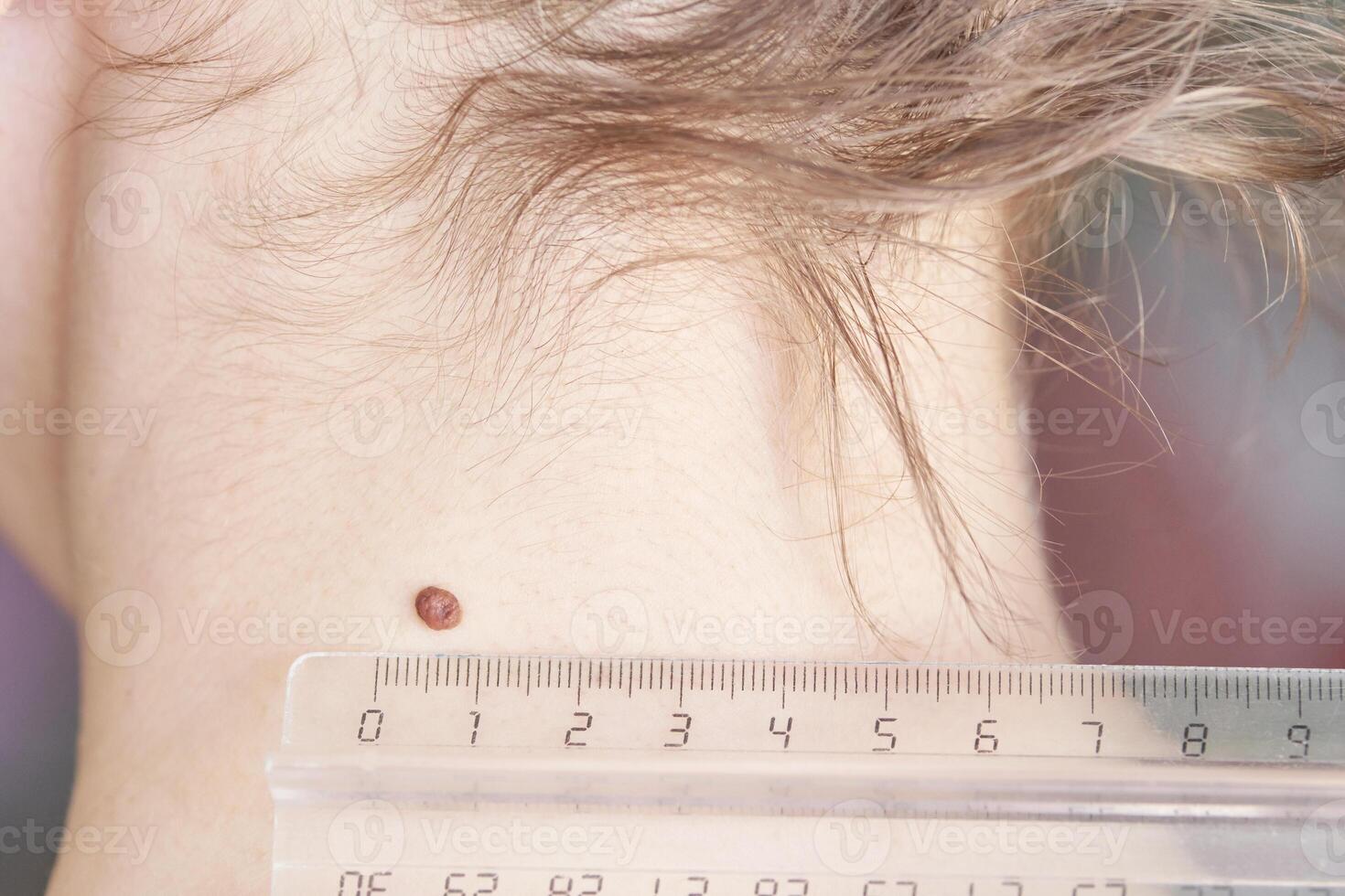 Woman examing her abnormal mole. Dermatology procedure. Doctor checking patient skin cancer melanoma. Dark wart at female neck. Back view. Removal papilloma treatment photo