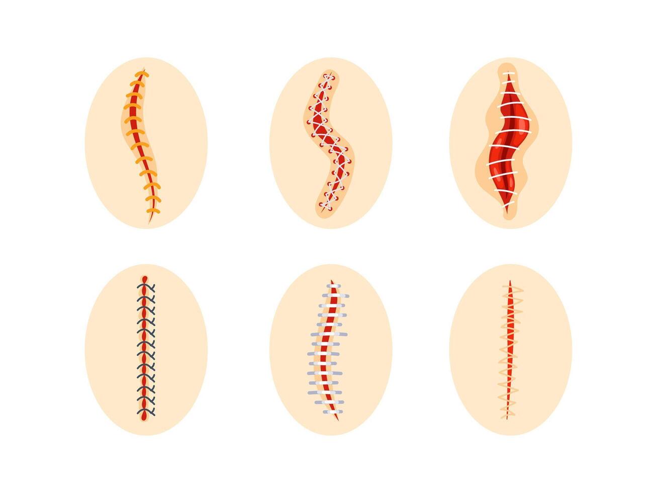 Collection of round icons representing various sutured wounds in different configurations, showing the process of surgical suture healing. vector