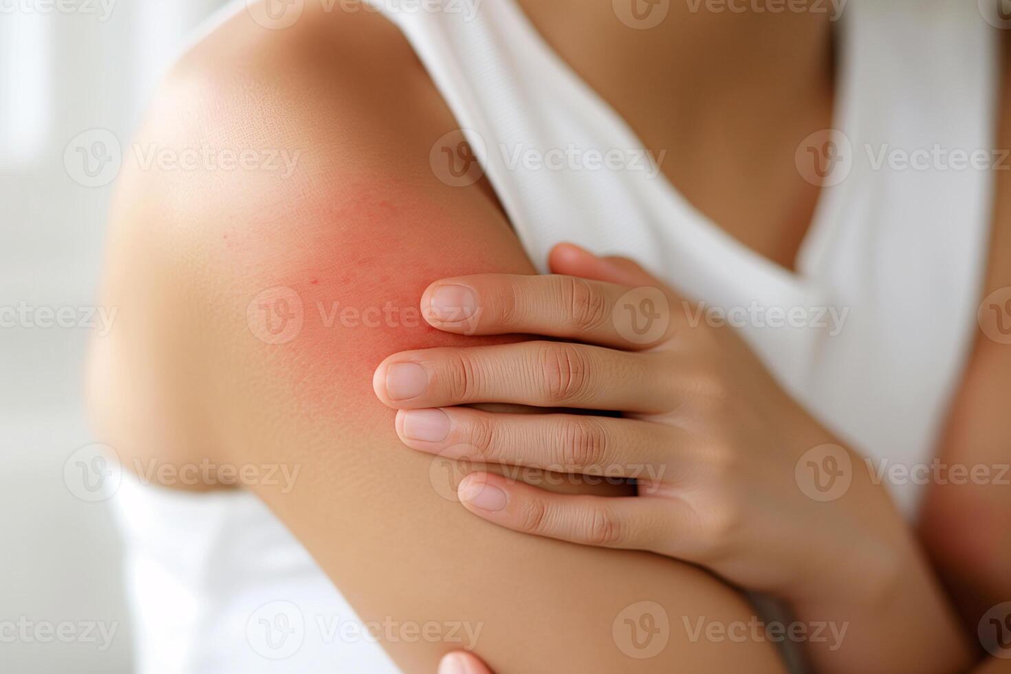 Close-Up of Woman's Arm with Red Rash Highlighting Skin Irritation and Allergy Reaction photo
