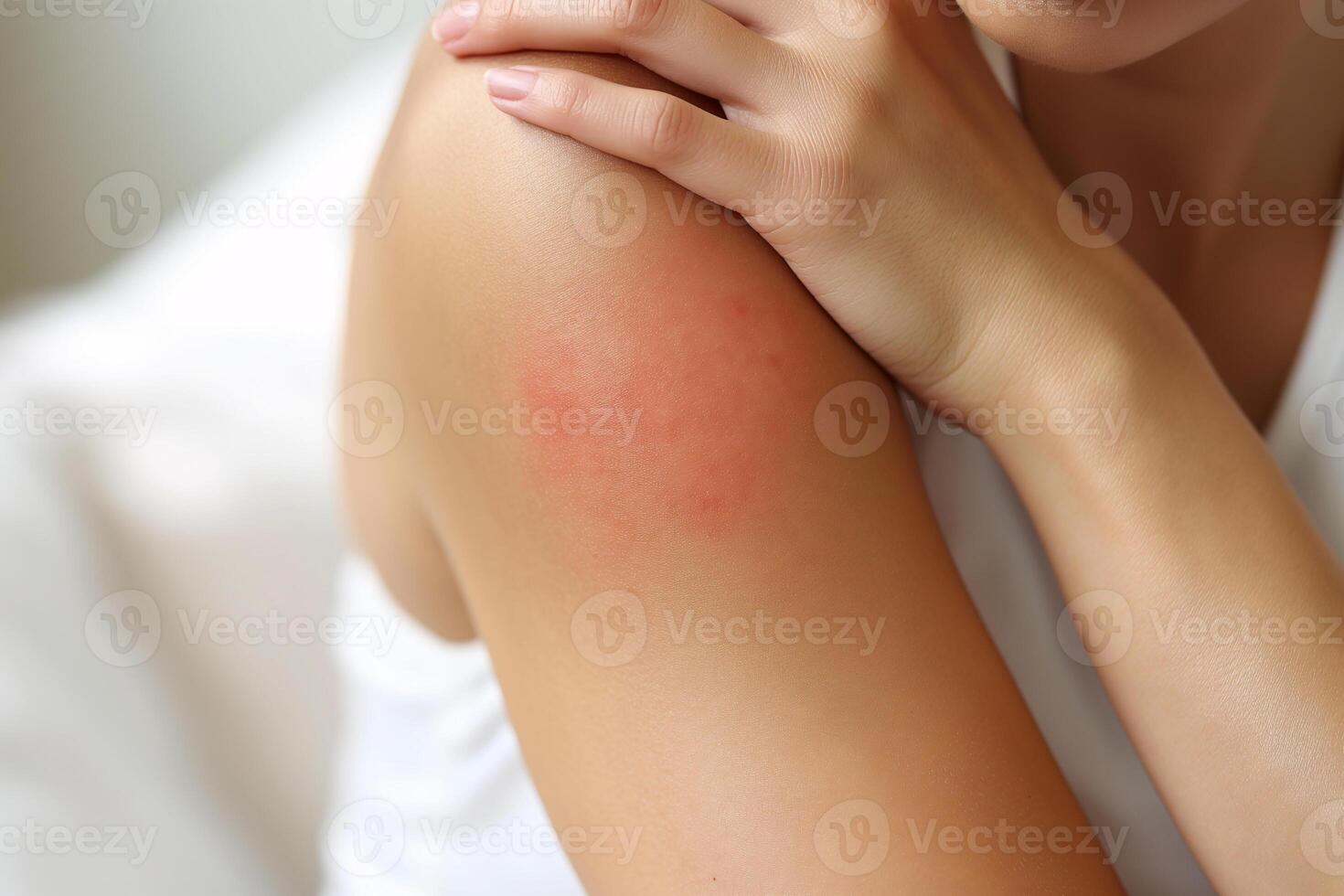 Close-Up of Woman's Arm with Red Rash Highlighting Skin Irritation and Allergy Reaction photo