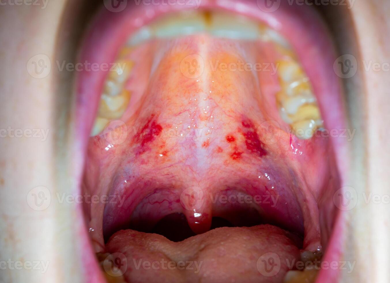 Inflamed throat of a sick person, red blood vessels of the upper wall of the oral cavity photo