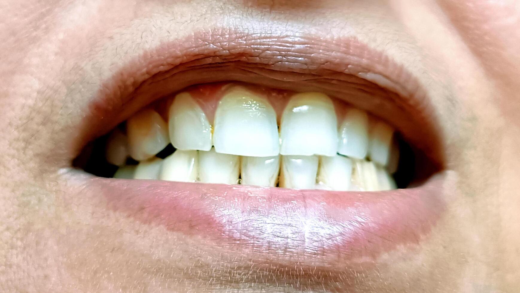 Woman shows her crooked teeth that needs medical help photo