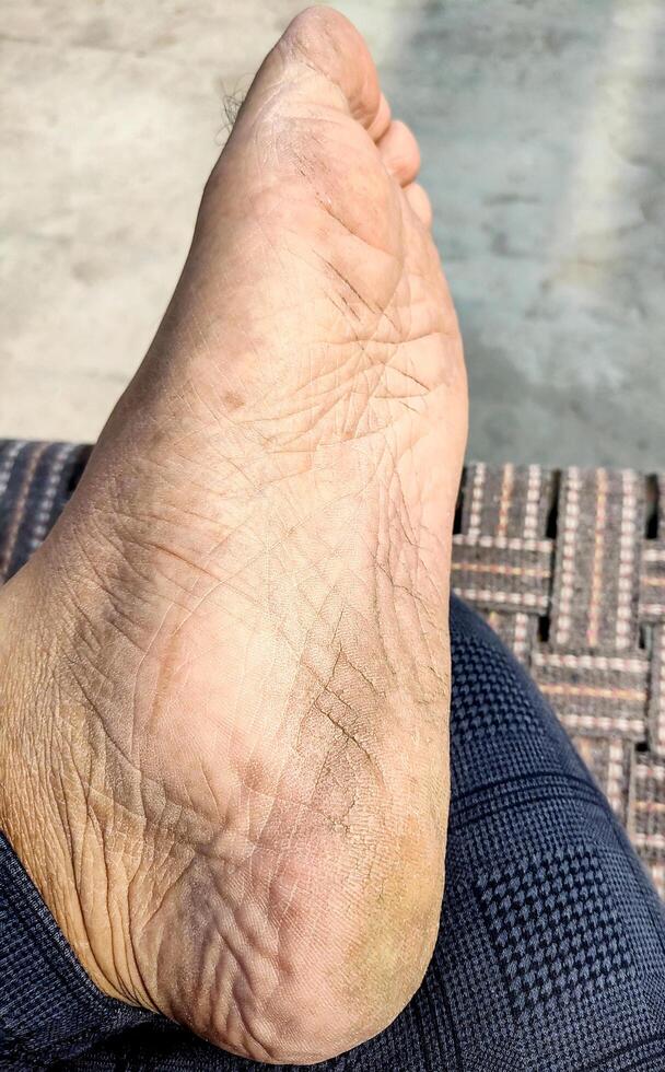 close up of young man dry feet photo