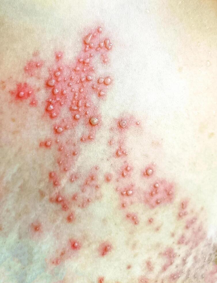 A Close up view of women with shingles herpes zoster disease on skin and he feel very painful photo