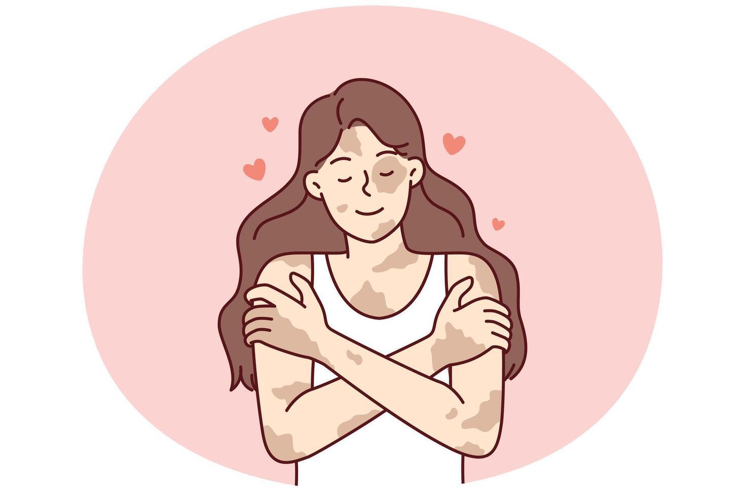 Positive girl with vitiligo disease hugging herself taking skin diseases as personal feature vector