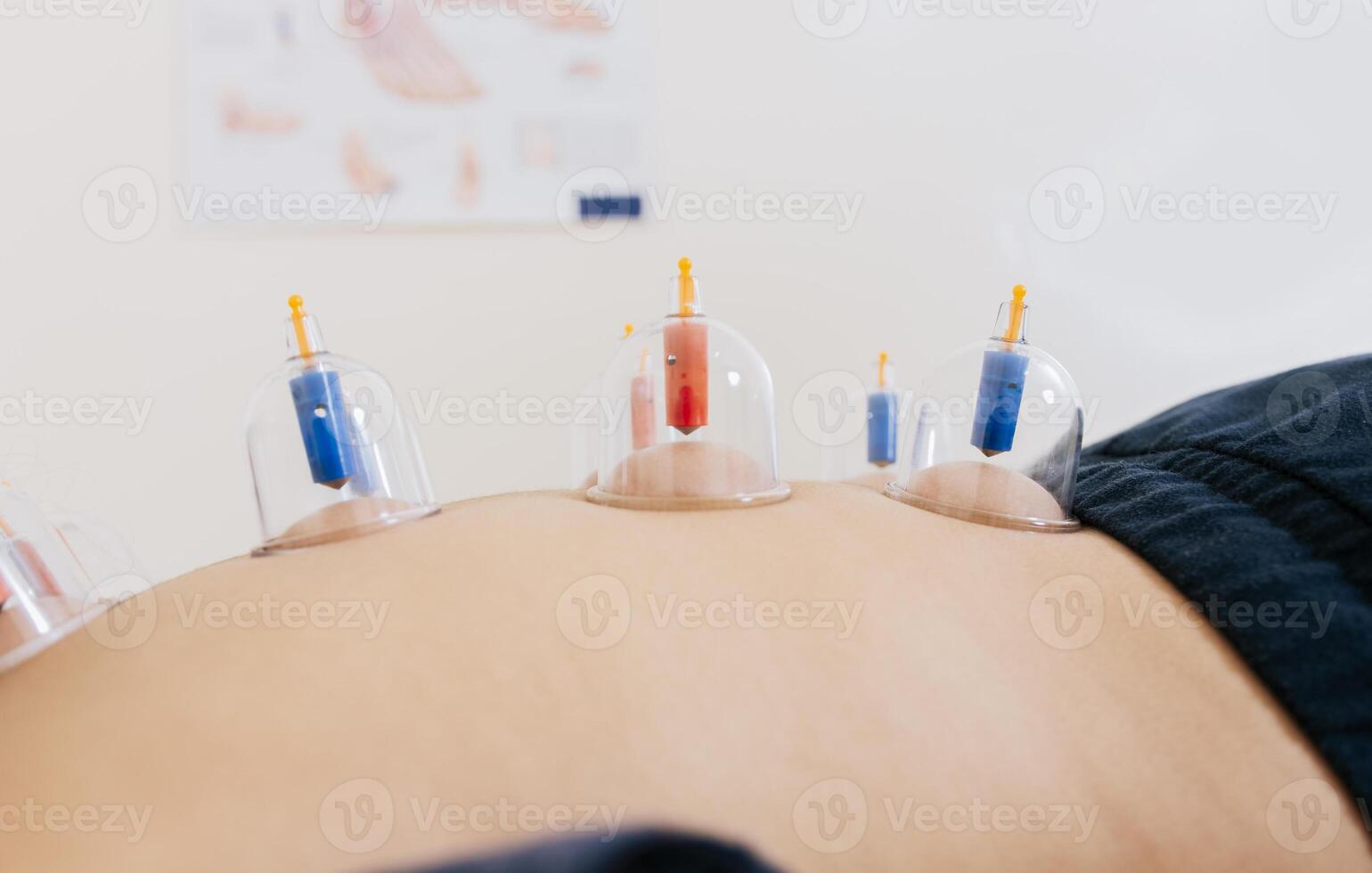 Close-up of suction cups on the patient back, Acupuncture cupping on the back of a person lying down. Patient lying down with suction cups on her back. Physiotherapy cupping on a lying patient photo