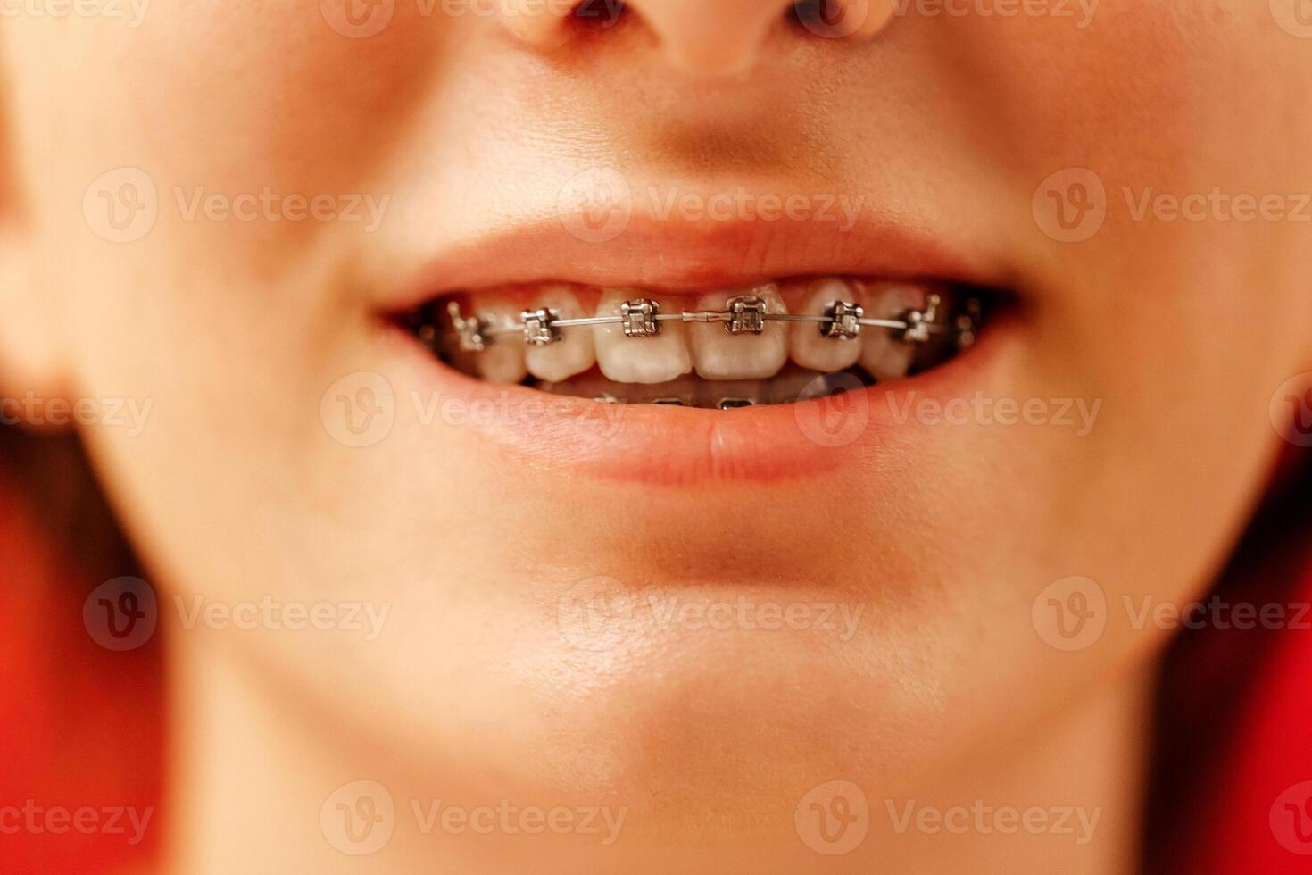 Close-up of a teenager mouth with dental braces. photo