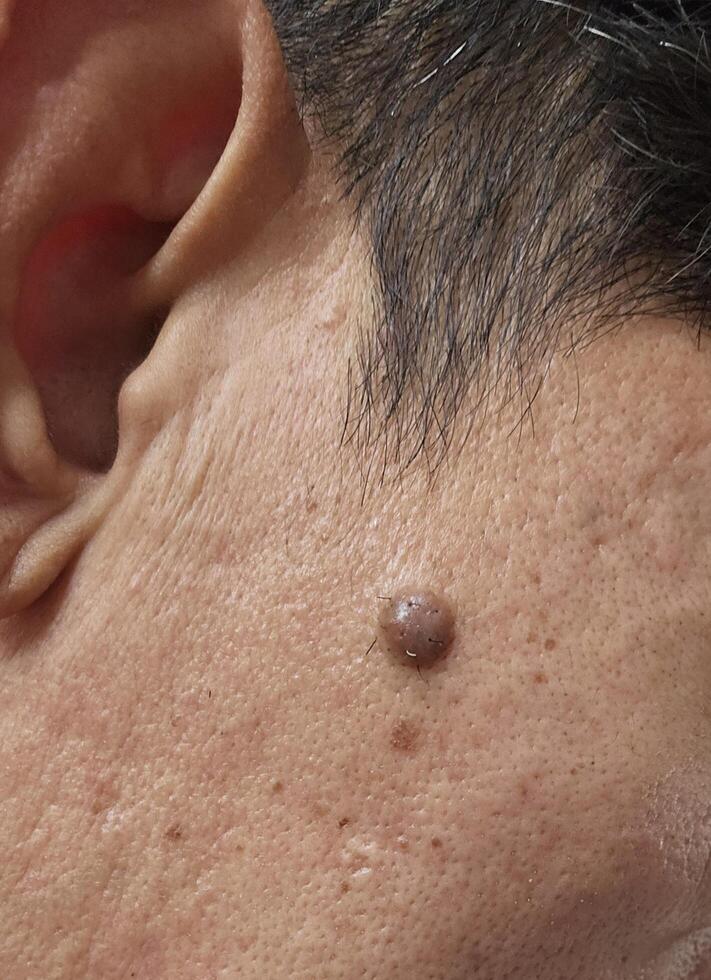 A mole on the face seen up close that enlarges and grows hairs photo