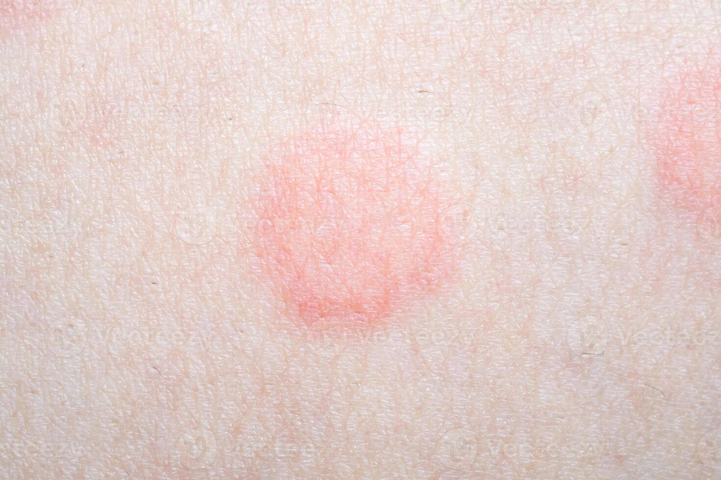 Skin allergy rash dermatitis texture close up photo