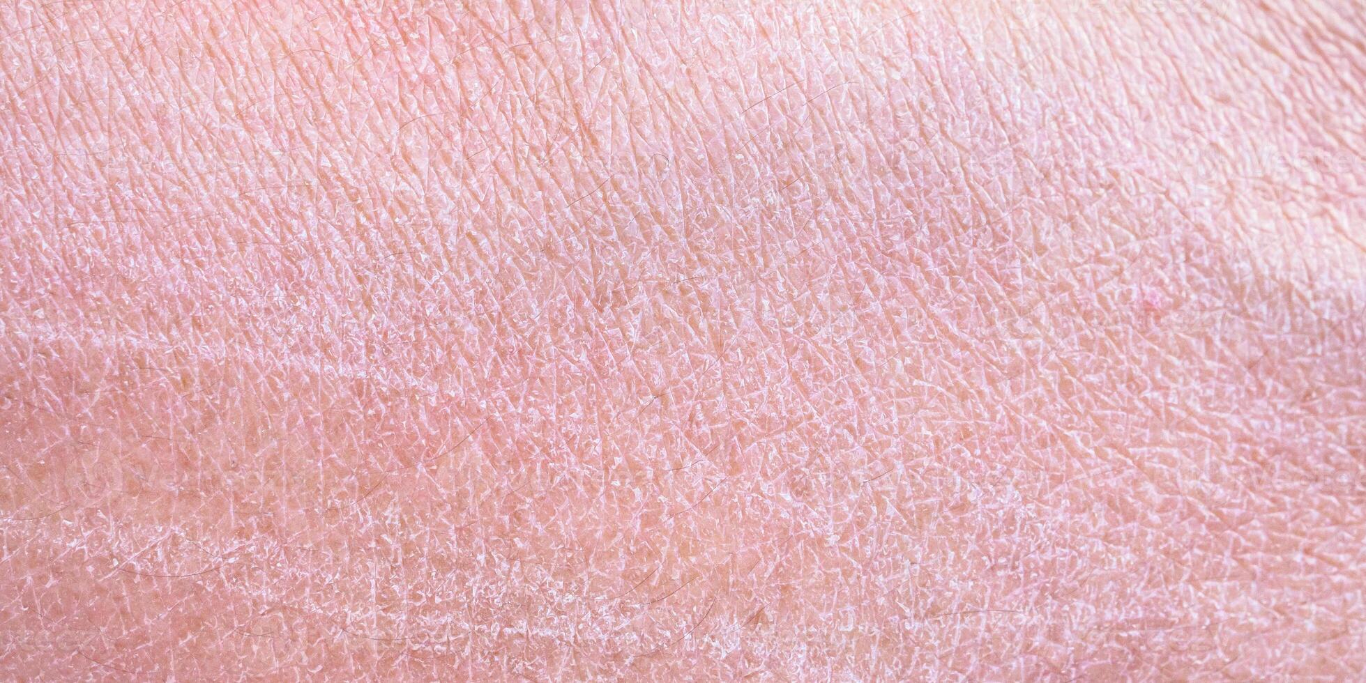 dry and dehydrated human skin texture background photo