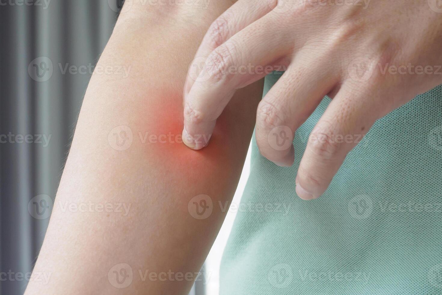 Young asian man itching and scratching on arm from itchy dry skin eczema dermatitis photo