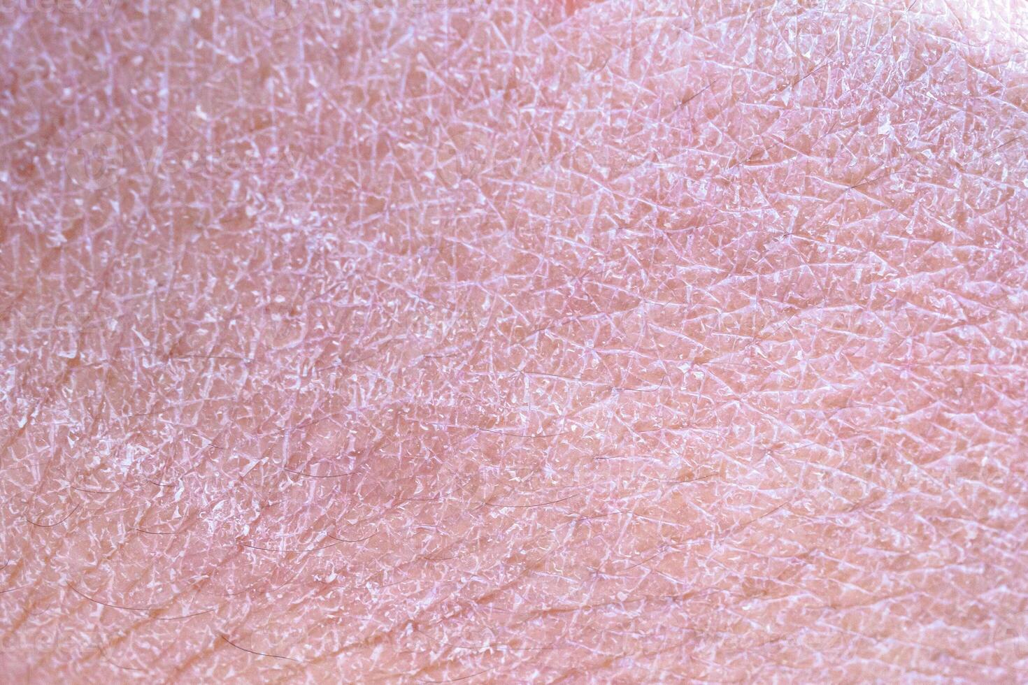 dry and dehydrated human skin texture background photo