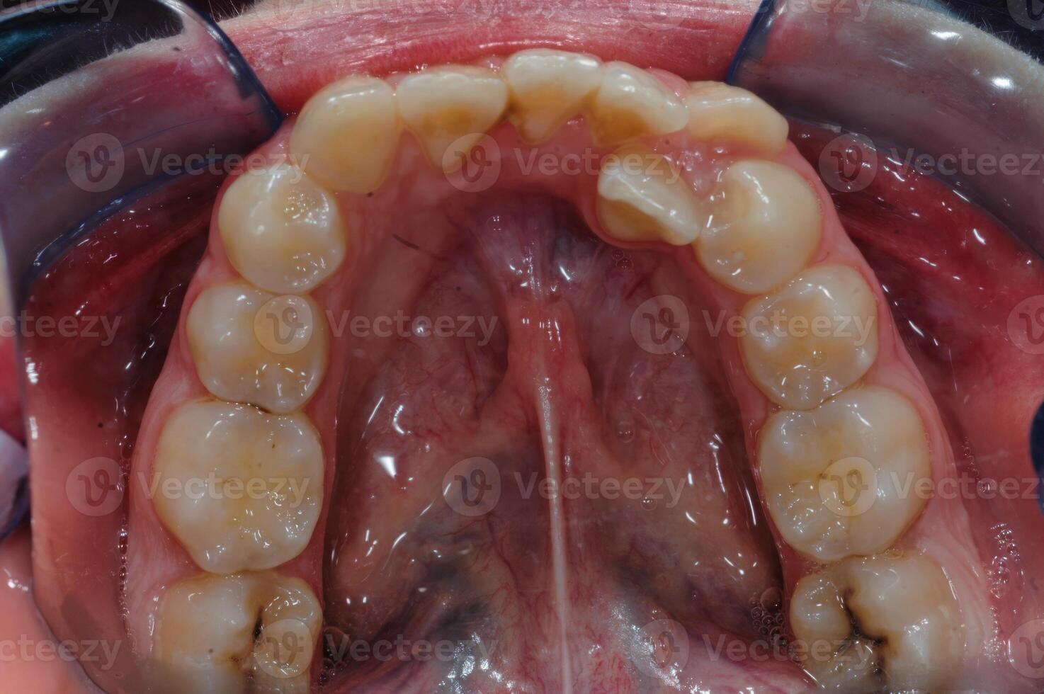 Close-Up of Adult Teeth During Dental Exam photo