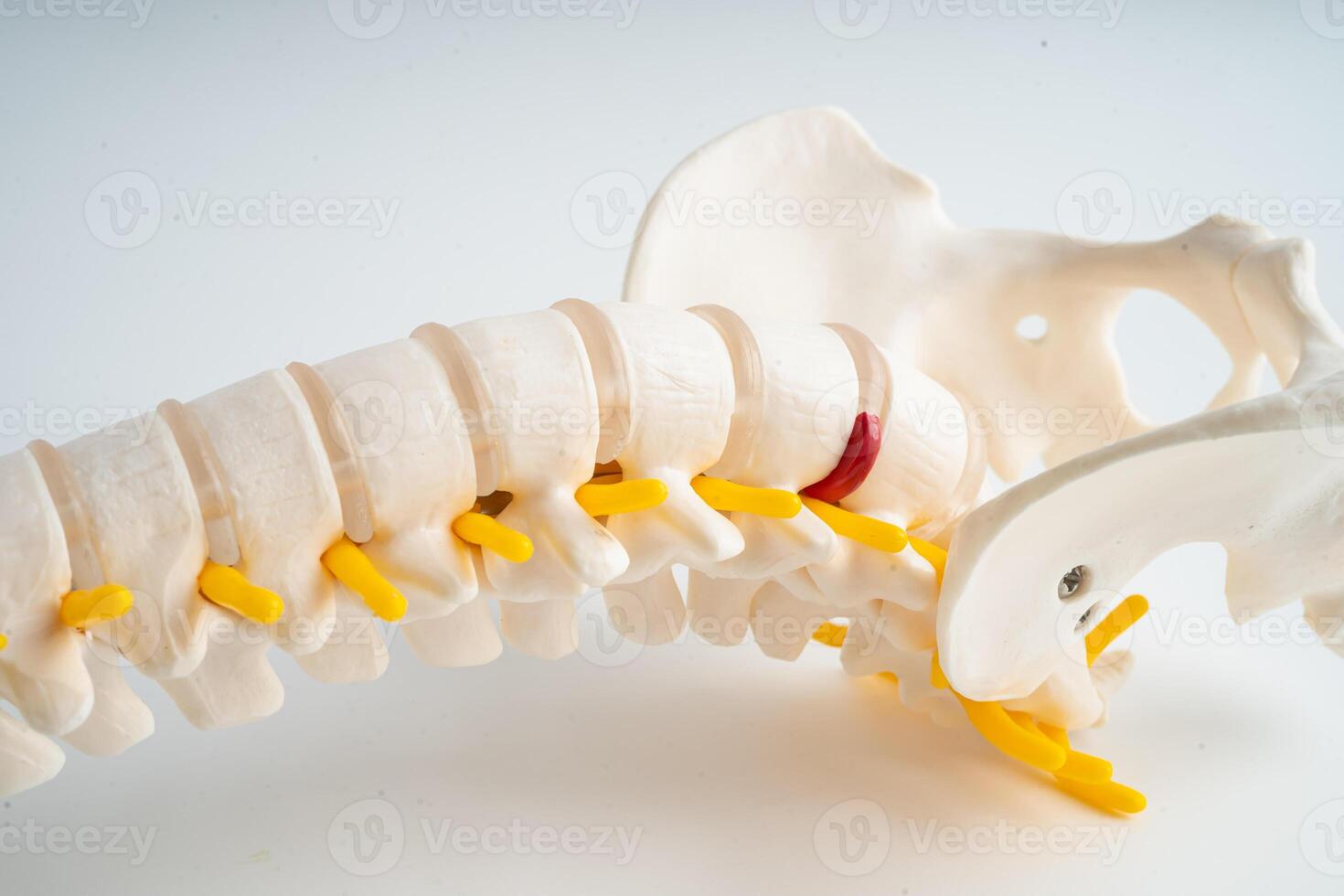 Lumbar spine displaced herniated disc fragment, spinal nerve and bone. Model for treatment medical in the orthopedic department. photo