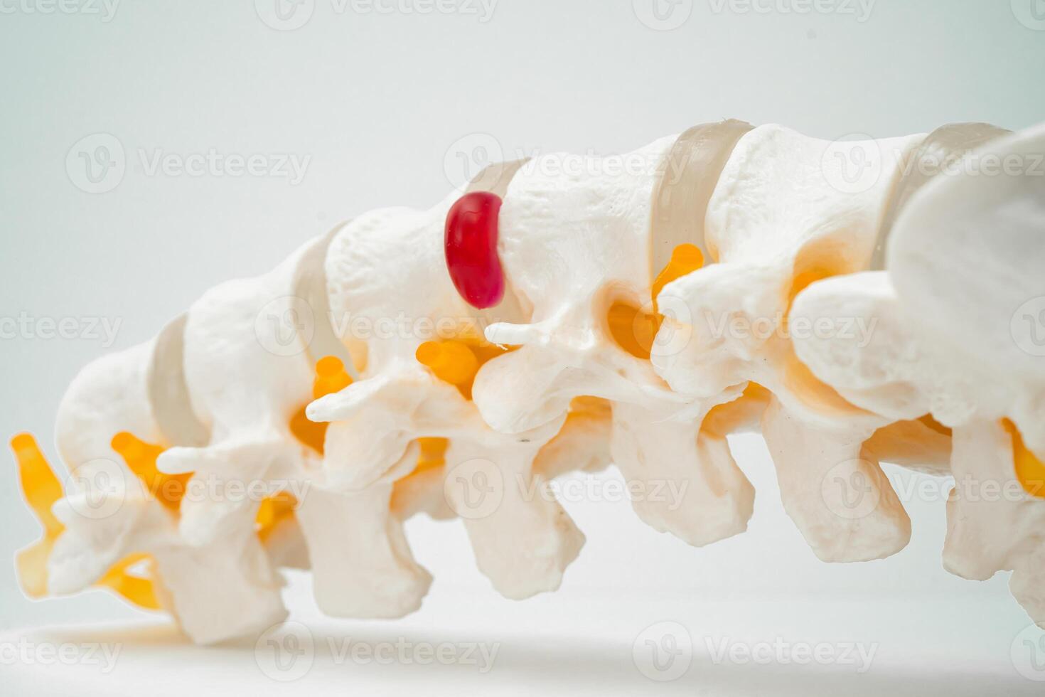 Lumbar spine displaced herniated disc fragment, spinal nerve and bone. Model for treatment medical in the orthopedic department. photo