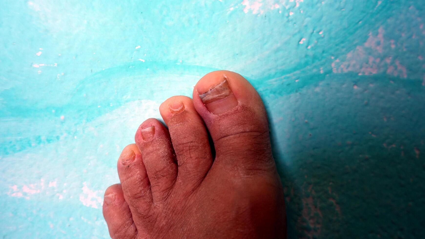 The nails and the skin of the foot are not in good condition. photo