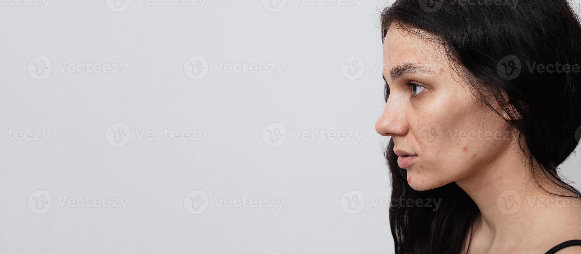A large portrait of a young woman with skin problems - pimples, acne, enlarged pores. A place for your text. photo