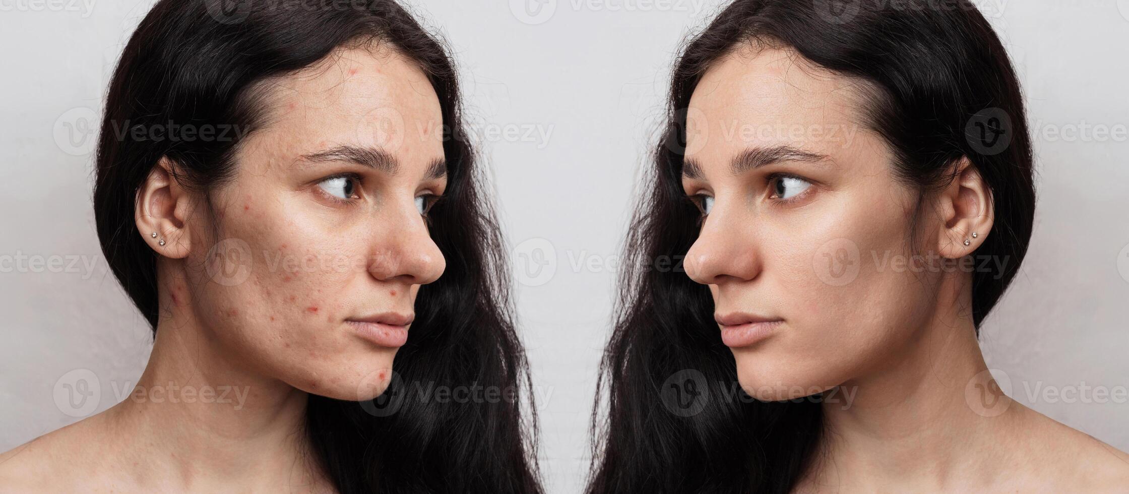 A young woman before and after acne treatment on a beige background photo