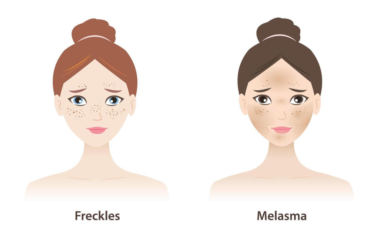 The women with freckles and melasma on skin face illustration isolated on white background. Types of pigmentation, Freckles, Ephelides, Solar Lentigines, Actinic lentigines and melasma. vector