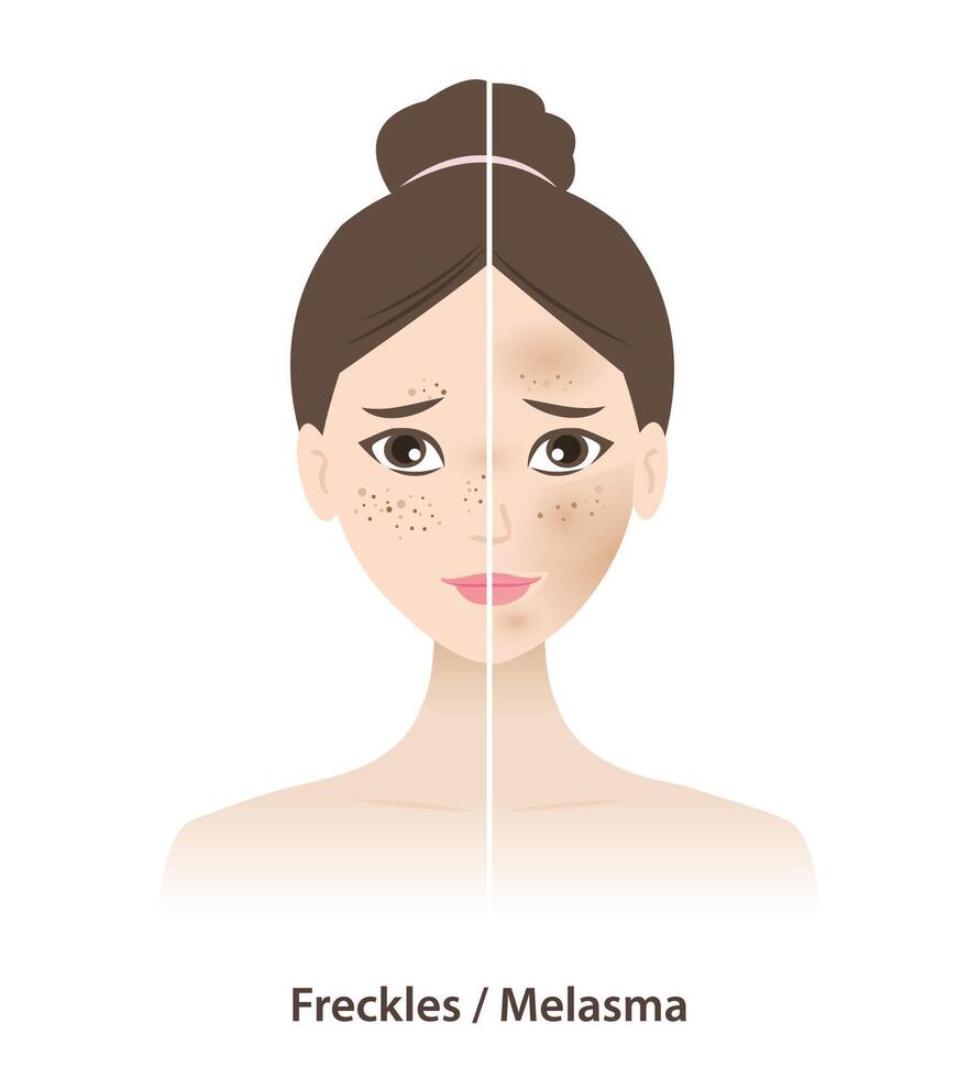 Comparison of freckles and melasma on skin woman face illustration isolated on white background. Types of pigmentation, Freckles, Ephelides, Solar Lentigines, Actinic lentigines and melasma. vector