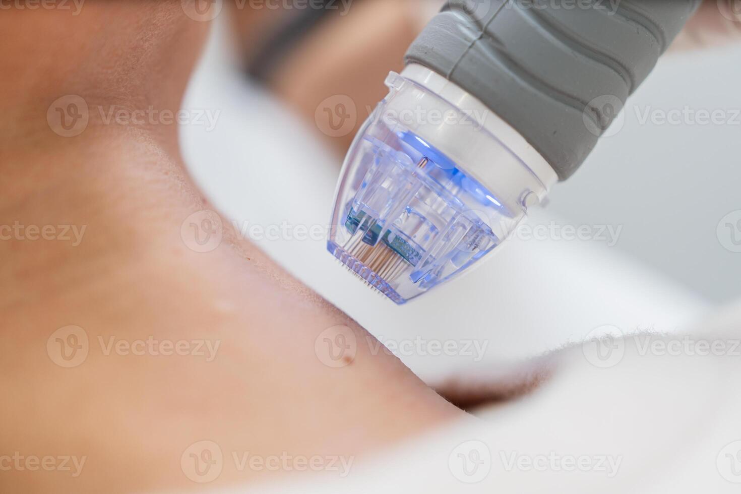 Microneedle RF lifting procedure. close up photo