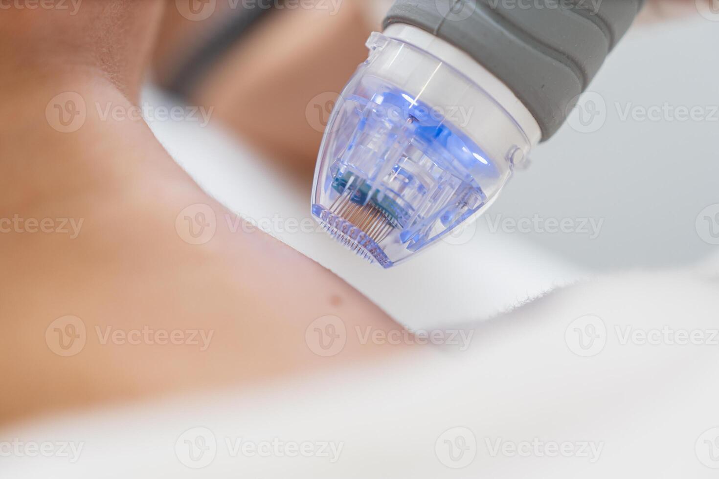 Microneedle RF lifting procedure. Hardware cosmetology. photo