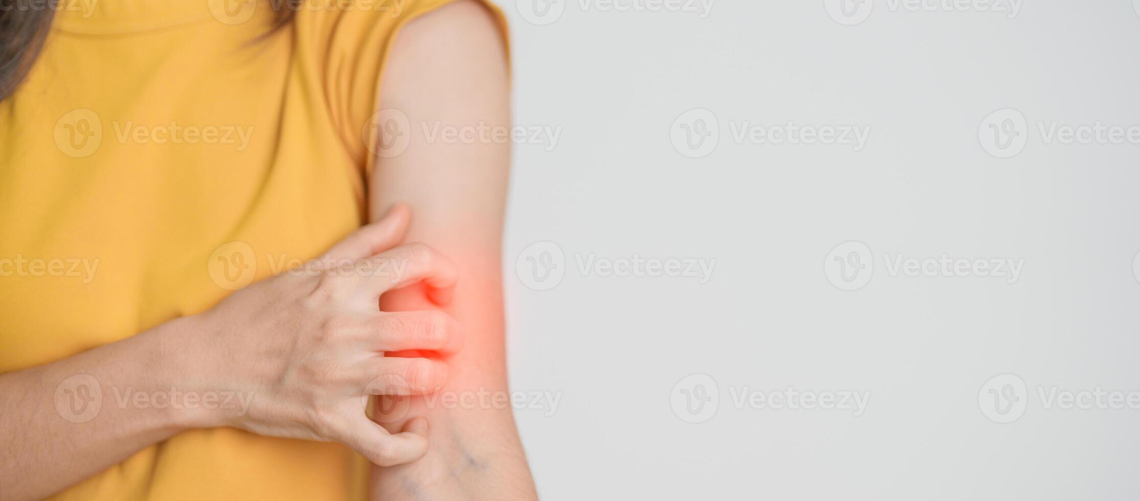 woman itching and scratching itchy arm. Sensitive Skin Allergic reaction to insect bite, food, drug dermatitis. Dermatology, Leprosy day, Systemic lupus erythematosus, Allergy symptoms and rash Eczema photo