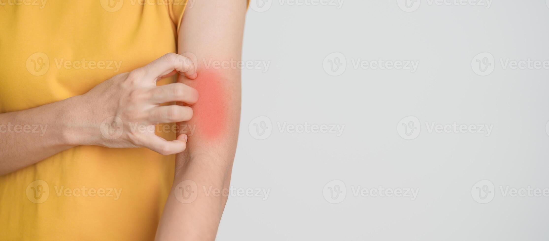 woman itching and scratching itchy arm. Sensitive Skin Allergic reaction to insect bite, food, drug dermatitis. Dermatology, Leprosy day, Systemic lupus erythematosus, Allergy symptoms and rash Eczema photo