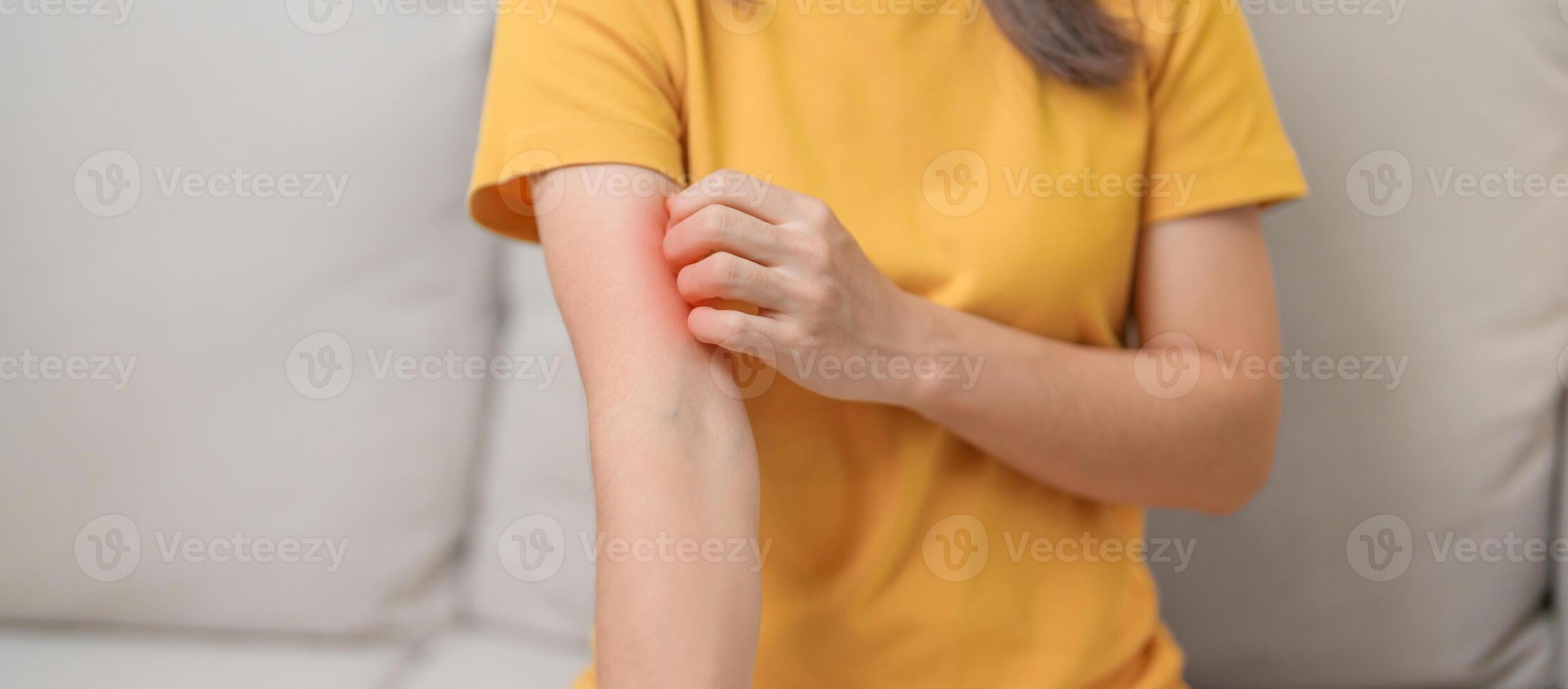 woman itching and scratching itchy arm. Sensitive Skin Allergic reaction to insect bite, food, drug dermatitis. Dermatology, Leprosy day, Systemic lupus erythematosus, Allergy symptoms and rash Eczema photo
