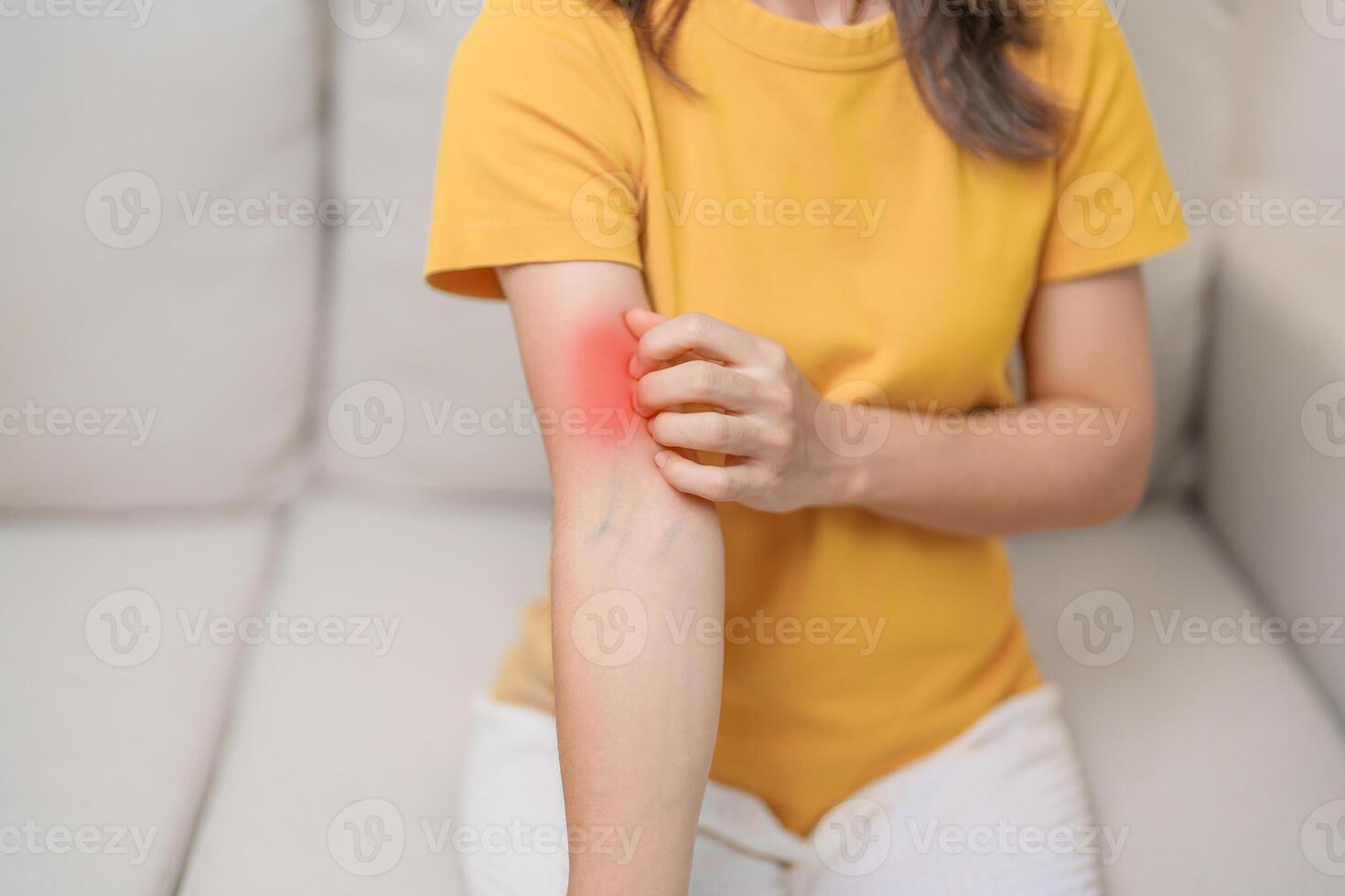 woman itching and scratching itchy arm. Sensitive Skin Allergic reaction to insect bite, food, drug dermatitis. Dermatology, Leprosy day, Systemic lupus erythematosus, Allergy symptoms and rash Eczema photo