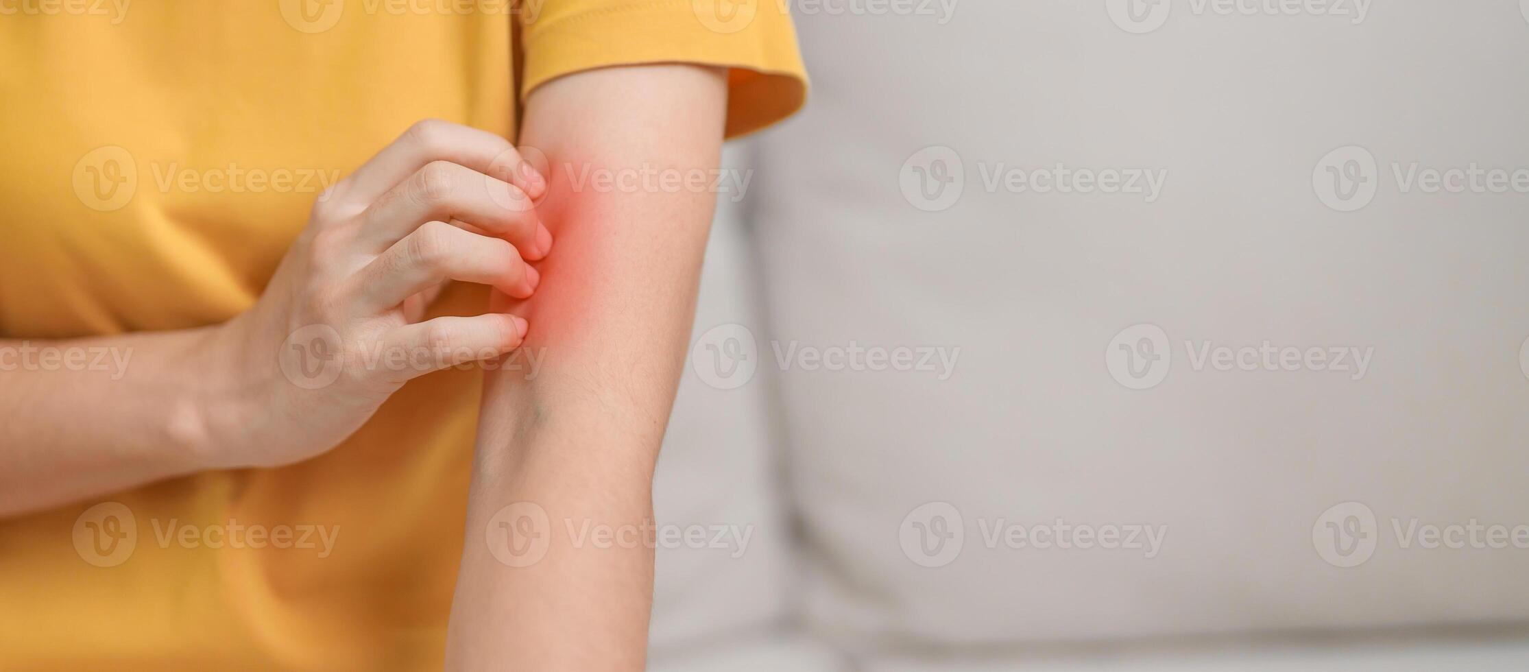 woman itching and scratching itchy arm. Sensitive Skin Allergic reaction to insect bite, food, drug dermatitis. Dermatology, Leprosy day, Systemic lupus erythematosus, Allergy symptoms and rash Eczema photo