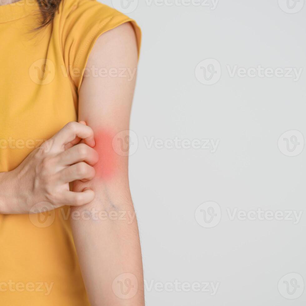 woman itching and scratching itchy arm. Sensitive Skin Allergic reaction to insect bite, food, drug dermatitis. Dermatology, Leprosy day, Systemic lupus erythematosus, Allergy symptoms and rash Eczema photo