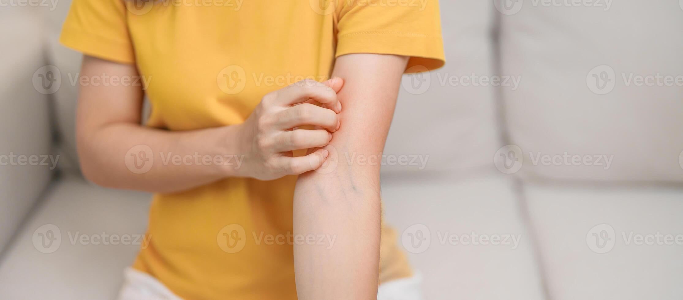 woman itching and scratching itchy arm. Sensitive Skin Allergic reaction to insect bite, food, drug dermatitis. Dermatology, Leprosy day, Systemic lupus erythematosus, Allergy symptoms and rash Eczema photo