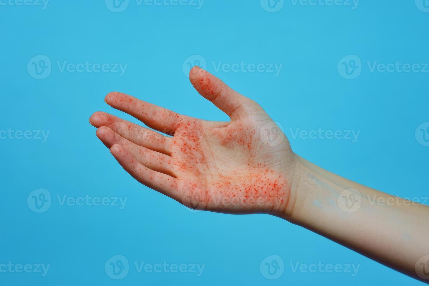 An image that showcases a male hand exhibiting an inflamed rash, which could potentially be caused by a viral infection or an allergic reaction. There is some available space for copy in the image photo