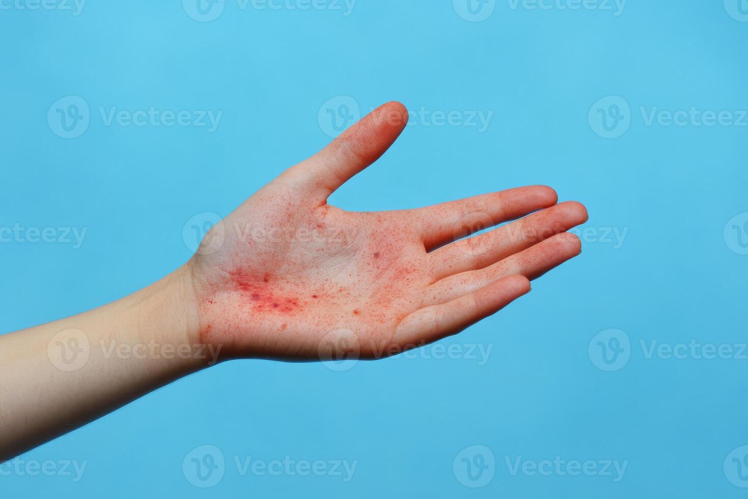 A male hand with red blisters may indicate a rash from a viral infection or allergic reaction, requiring prompt evaluation and treatment by a qualified healthcare professional for proper care photo
