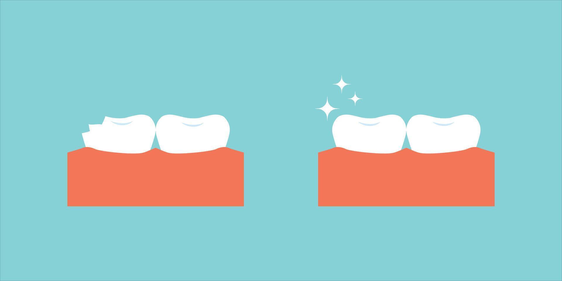 Injury chipped tooth and healthy tooth before, after treatment icon set. Broken teeth with problem treatment concept. vector
