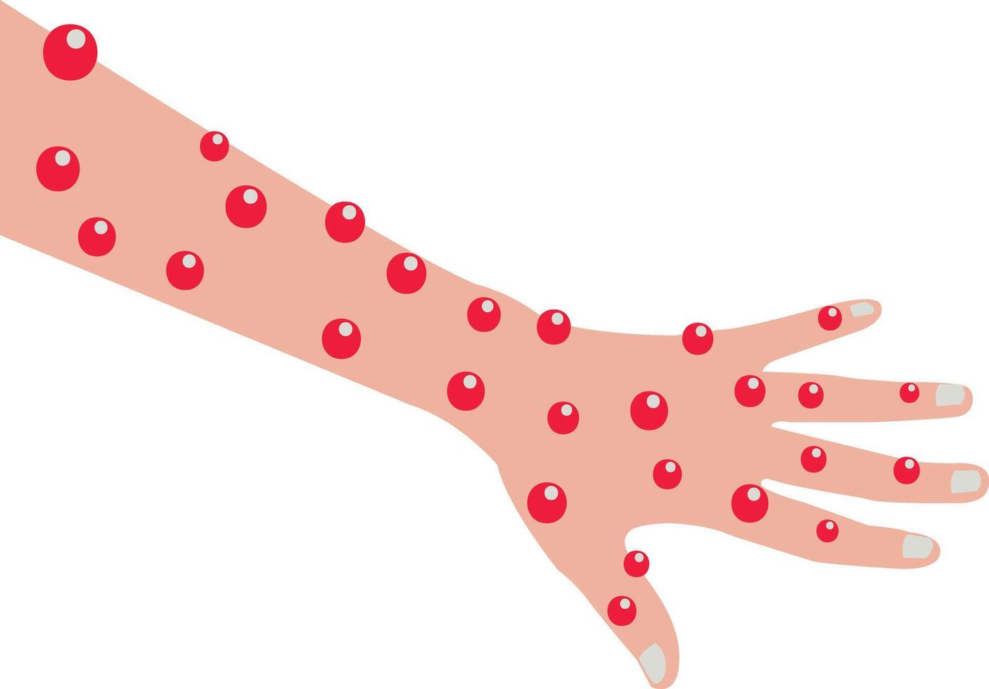 Monkeypox Rashes on the Hand Illustration vector