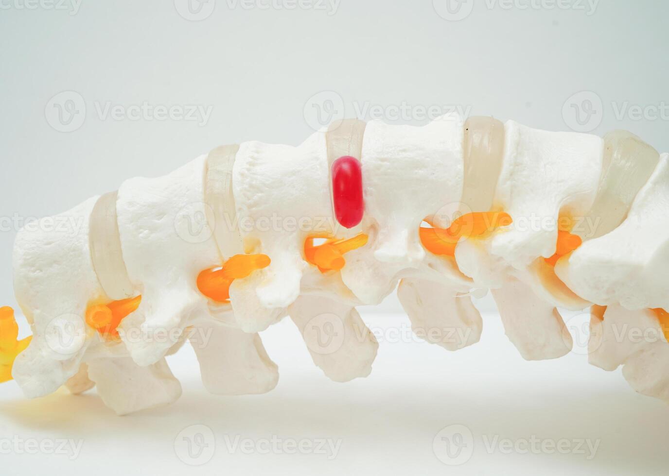 Spinal nerve and bone, Lumbar spine displaced herniated disc fragment, Model for treatment medical in the orthopedic department. photo