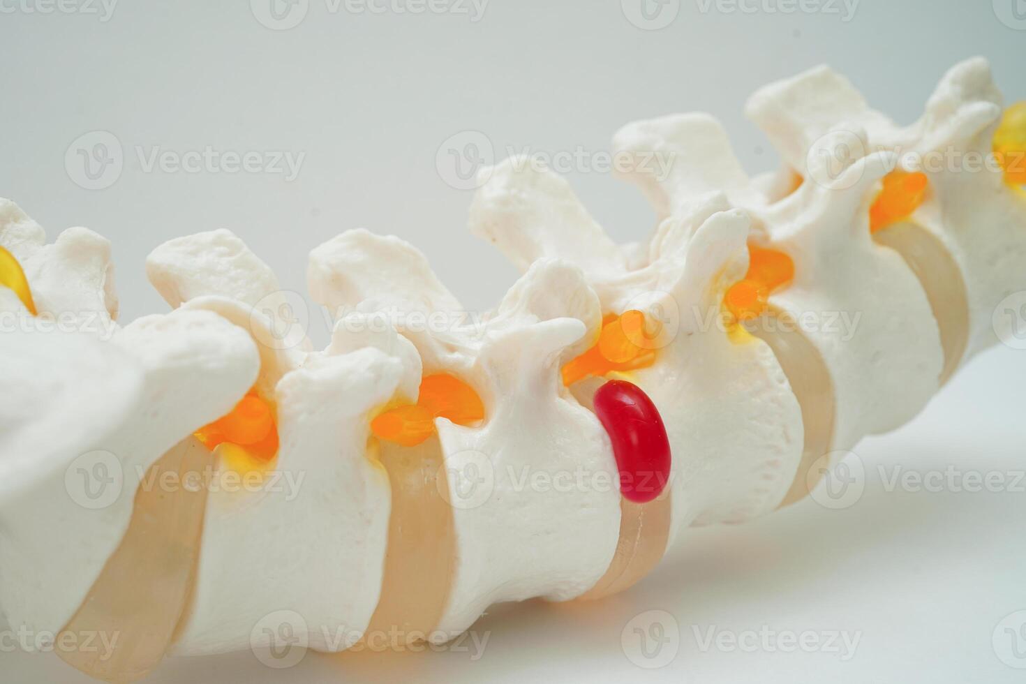 Spinal nerve and bone, Lumbar spine displaced herniated disc fragment, Model for treatment medical in the orthopedic department. photo