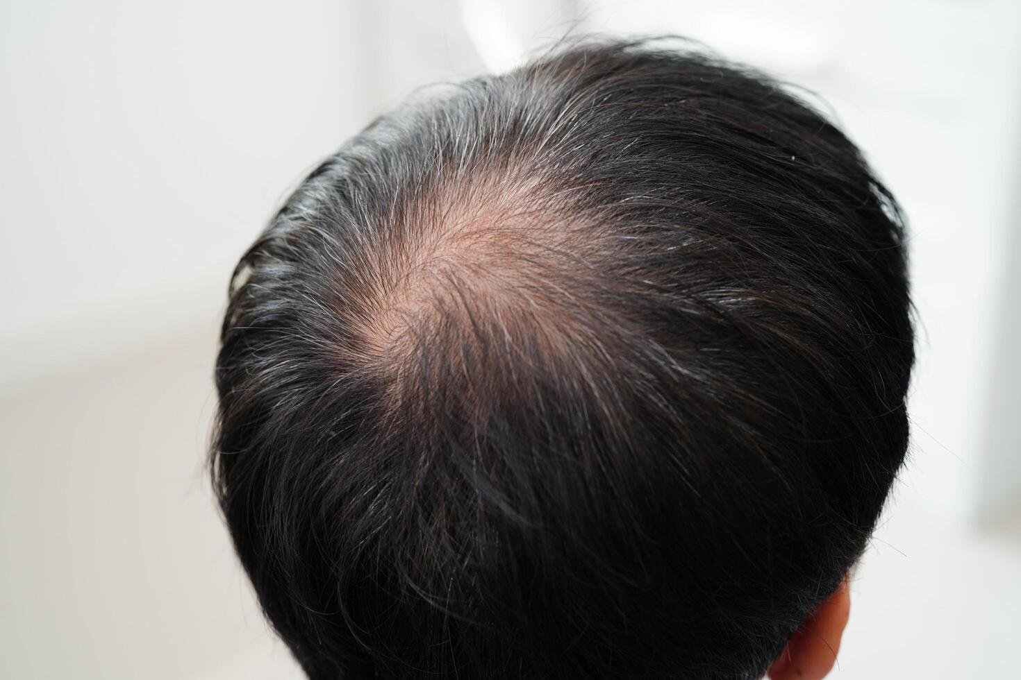 Bald head in man, hair loss treatment health problem. photo