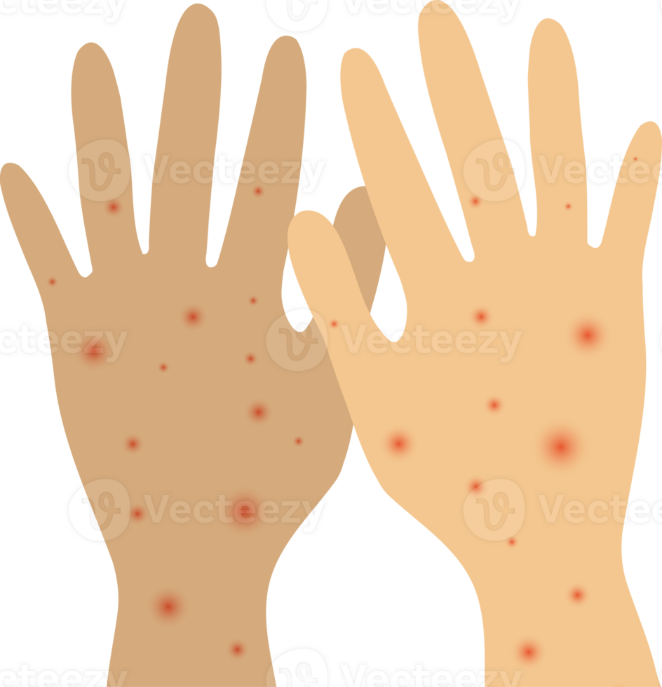 Infected person's hands with Mpox monkeypox virus. Illustration of visible rash and red lesions symptoms of the Monkeypox virus. png