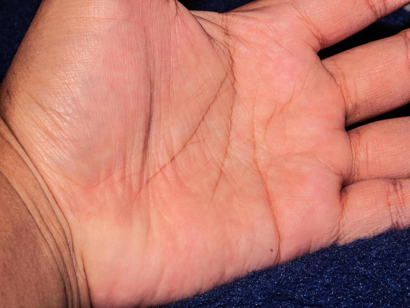 Closeup view of horizontal simian line on the palm of hand photo