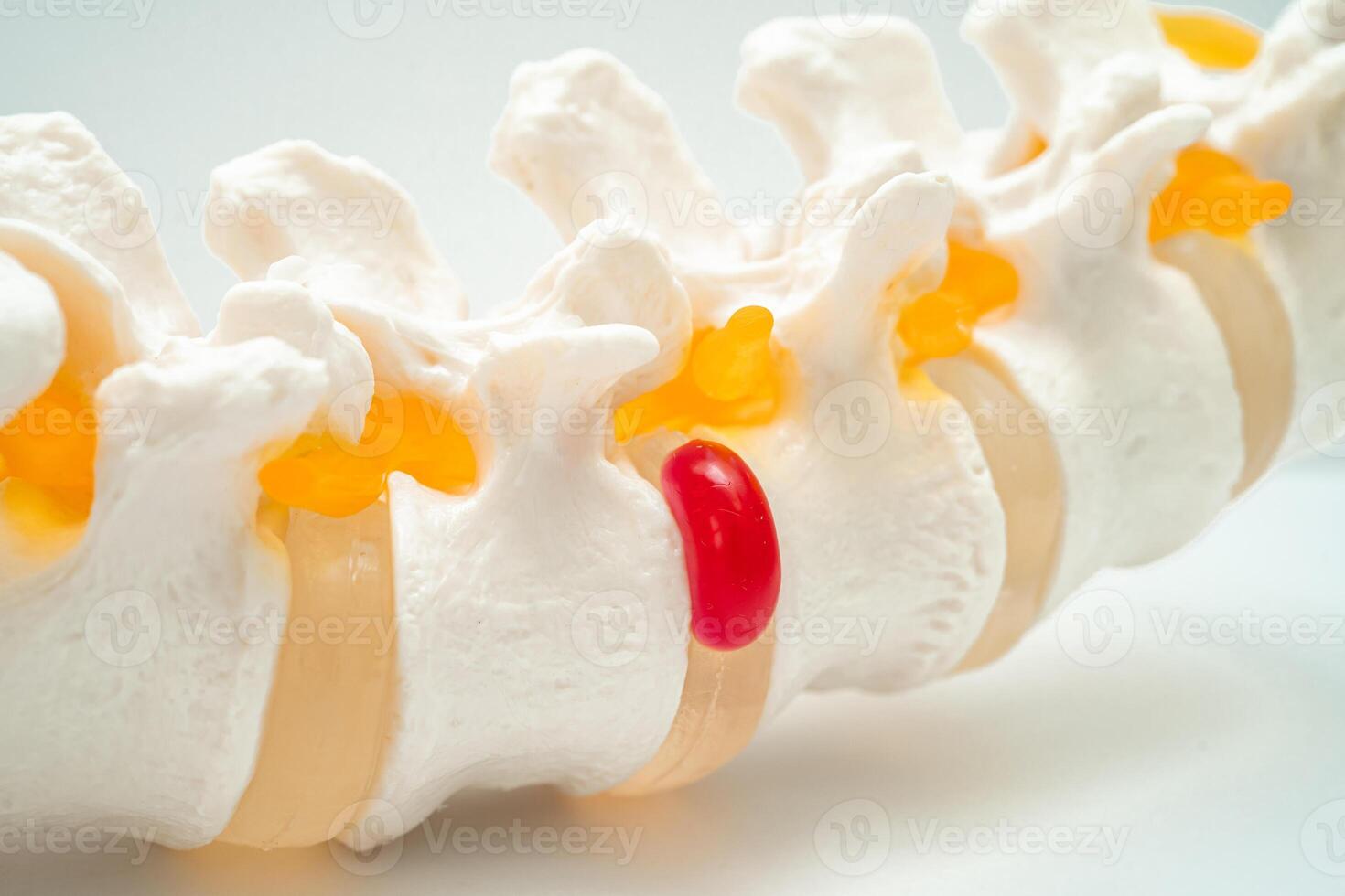Lumbar spine displaced herniated disc fragment, spinal nerve and bone. Model for treatment medical in the orthopedic department. photo