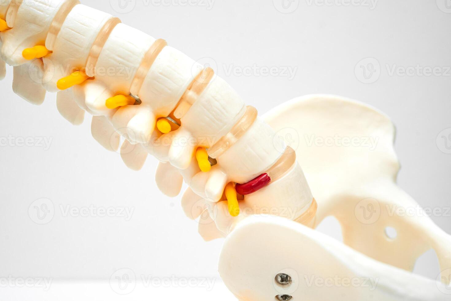 Lumbar spine displaced herniated disc fragment, spinal nerve and bone. Model for treatment medical in the orthopedic department. photo