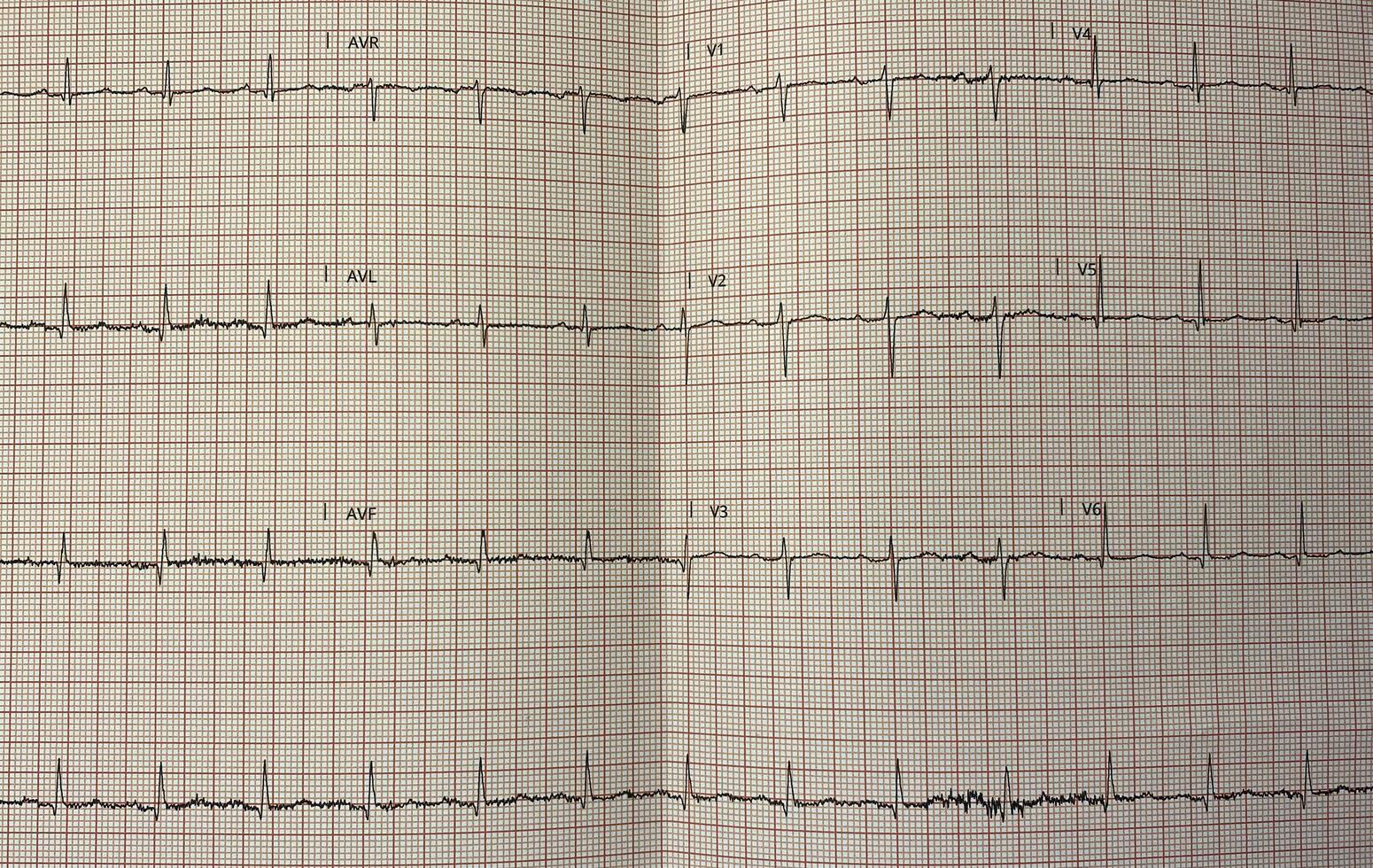 Electrocardiogram in paper form. Electrocardiographic recording. ECG example. photo
