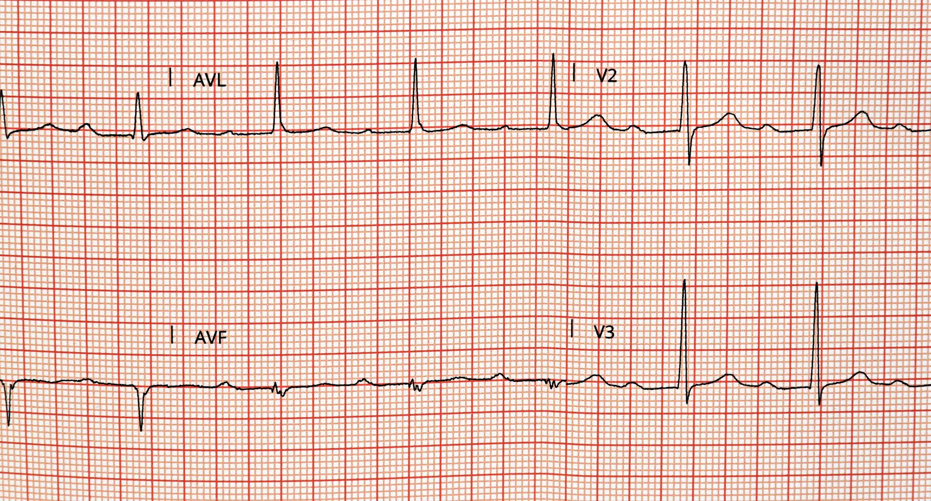 Electrocardiogram in paper form. Electrocardiographic recording. ECG example. photo